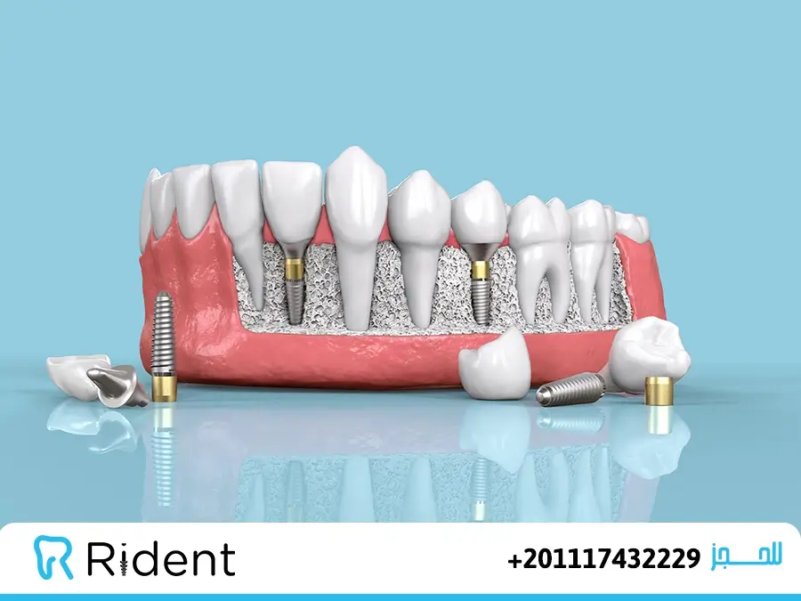 Immediate Dental Implants