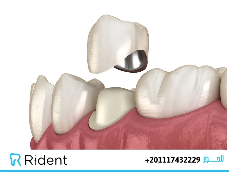 طربوش الاسنان عيوبه و مميزاته