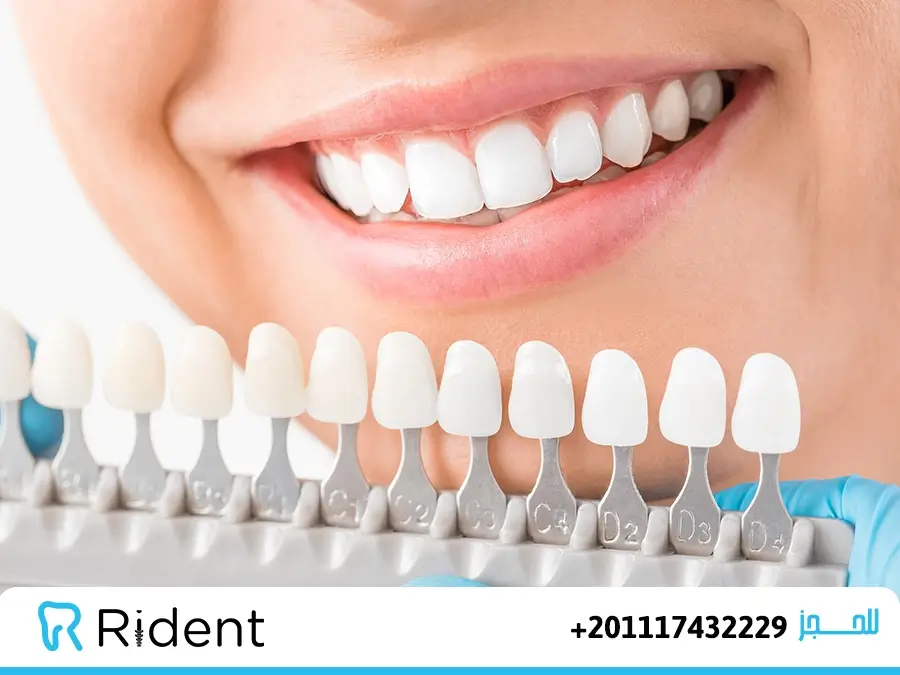 Dental Veneers